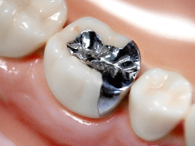銀歯って日本だけ？古い歯の治療跡にしのびよるリスク | ウィステリア ...